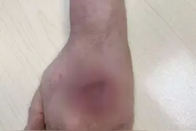 警惕！女子洗鱼被刺后未在意，手背长出大窟窿差点截肢图片