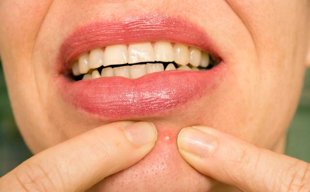 非角化型细胞额