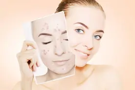 关于刷酸你需要知道的10件事情，刷酸并不是可怕的护肤手段图片