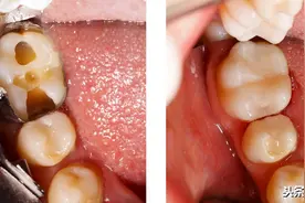 牙齿该如何修复图片