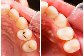 牙齿被蛀空却又不疼，放着不管会影响健康吗？听听专业牙医怎么说图片