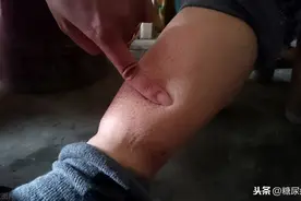 糖尿病患者为什么会出现水肿，应该如何治疗图片