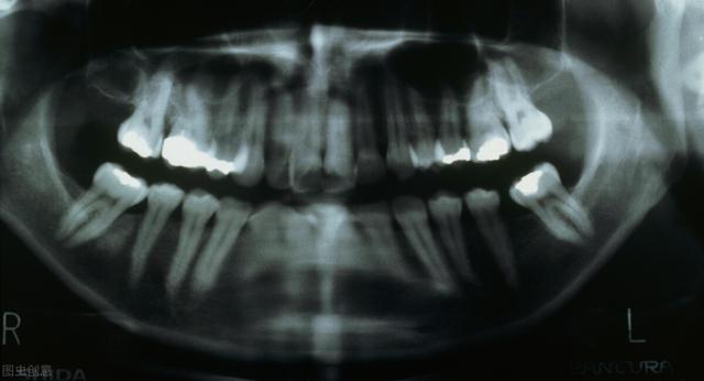 角化囊肿发展迅速