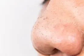 毛孔粗大怎么破？改善黑头粉刺痤疮，皮肤科医生教你正确护肤图片