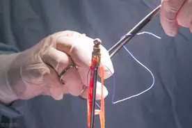 骨折后钢板一定要取？这几种情况，可能还是不取比较好图片