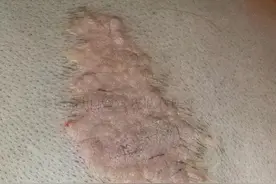 头面部的“肉疙瘩”——皮脂腺痣图片