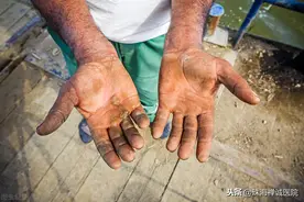 触目惊心！珠海一名17岁男孩干活时4个手指被压断图片