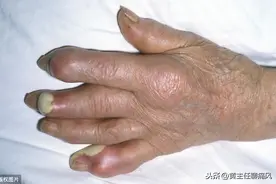 患了痛风真的一点肉也不能吃吗？有没有肉类是例外呢？一文全解答图片