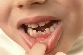 关于孩子换牙，这些“小事儿”你有必要了解图片