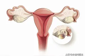13岁女孩腹部鼓胀，医生检查后发现，肚子里长了这个东西图片