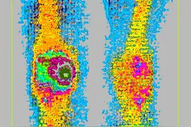 骨坏死是什么原因？股骨头坏死忌什么？图片