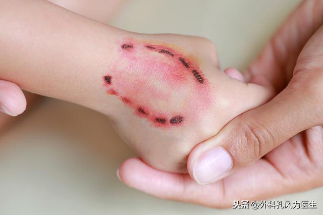 感染上狂犬病病毒，一旦发病，生存期不超过5天，几乎100%死亡
