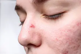 痘痘肌需要注意的几个护肤问题，别再遭受反复长痘的困扰了图片