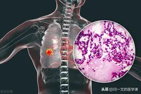 哪种肺癌预后最好？哪种肺癌预后最差？肺癌预后排序及分类图片