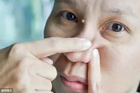 祛黑头没有那么难，教你三招搞定图片