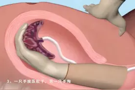 6张图完整演示“手剥胎盘”过程，经历过的产妇：疼的灵魂出窍图片