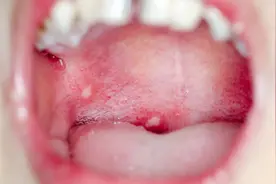 口腔溃疡长期不愈，一查竟然是癌图片