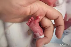 极早产婴儿出生仅29厘米，体重580克，在保温箱住140天后出院图片