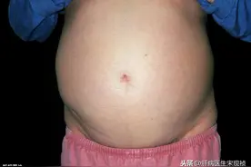 有了肝腹水怎么办？牢记三点，轻松赶走“腹水”图片