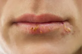 每个喜欢舔唇、撕嘴皮的人，都是潜在的唇炎患者图片