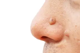 70岁奶奶脸上突然多了颗“福痣”，一查竟是癌！这几种地方长痣，千万要警惕图片