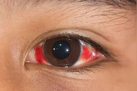 突发白睛溢血-球结膜下出血图片