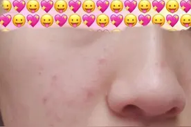 脸上的痘痘可以长期放任不管吗？我的经验是一定要处理图片