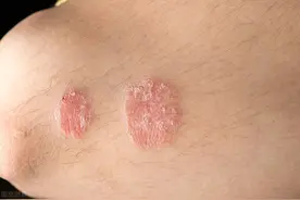 怀疑自己是银屑病？这6个皮肤表现，如果中招赶快就医图片
