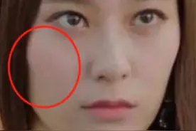 颧弓外扩，颧骨突出，面部线条不流畅？那也不要做医美填充！图片