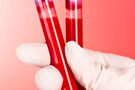 皮肤无故淤青到底是怎么回事？警惕免疫性血小板减少症图片