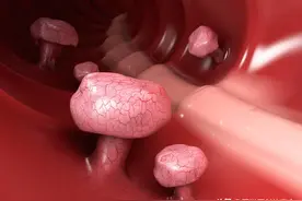 大肠息肉开始癌变，肿瘤科医生忠告，四个症状别再一拖再拖图片