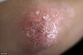 牛皮癣病人春季饮食注意事项有哪些？图片