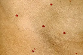 长红痣，是肝病的标志吗？在中医眼中，还有这2种原因，不妨看下图片