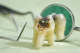 牙齿上的小黑点，不疼又不痒可以不用管吗？其实背后隐患真的很大图片