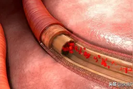 身上有2处凸出，说明血管开始硬化，要注意起来图片