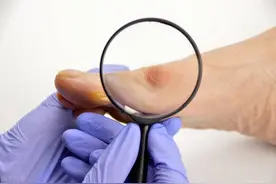 65岁，感觉脚底疼？医生：小心拇外翻，保守治疗可以这么办图片