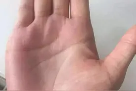 手诊自查脑血栓，如何自己急救，防止脑溢血留下后遗症，麻烦家人图片