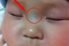 宝宝鼻梁有青筋，是脾气大的表现？不全是，还蕴含着孩子是否健康图片