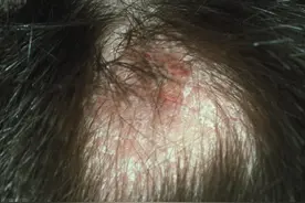 儿童容易长头癣，那头癣能治愈吗，如何进行预防图片