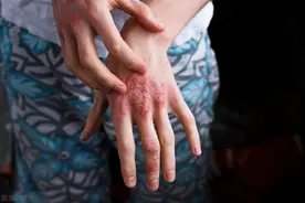 患上红斑狼疮能活多久？比癌症还难缠！出现5个信号，赶紧看医生图片