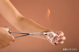 拔罐起水泡，是排毒，还是忽悠图片