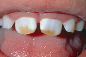 为什么别人的牙齿很整齐，自己的牙齿却很乱呢？图片