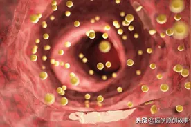 结肠开始癌变，大便会有四个标志，若你四个都有，提示该体检了图片