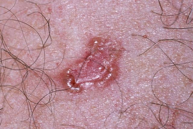 肺鳞癌角化珠形成