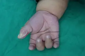 10个月宝宝长六指，医生建议2岁之内尽早手术治疗图片
