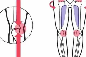 矫正腿型问题，你一定要知道先从这2点入手图片