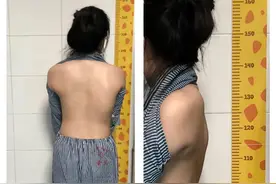 脊柱侧弯8年后被“掰”直，东莞一女子增高4厘米图片