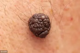 你有“痣”命危险吗？快来对照下图片