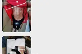 被虐女童转至哈尔滨治疗，知情人：医院曾多次报警，凡凡父母称孩子“自残”图片