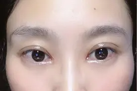 谈谈个人割双眼皮的感想及告知注意事项，风险图片